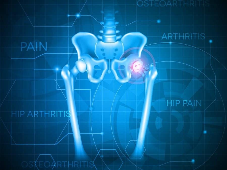 What is Hip Osteoarthritis?