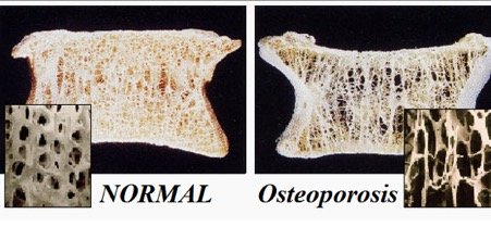 cross-section image of normal and osteoporosis bones